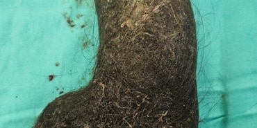 9 yaşındaki çocuğun midesinden saç yumağı çıktı