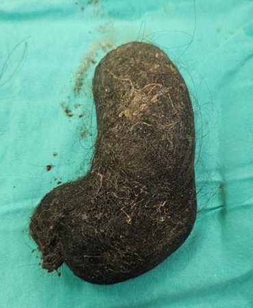 9 yaşındaki çocuğun midesinden saç yumağı çıktı