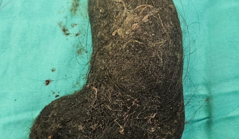 9 yaşındaki çocuğun midesinden saç yumağı çıktı