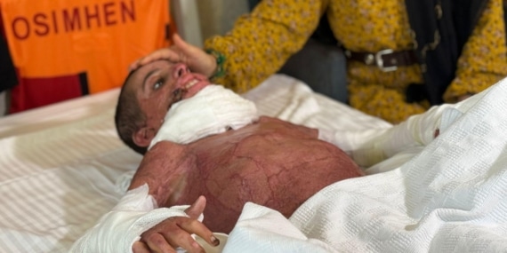 Vücudunun yüzde 50’si yanan Mustafa, yapay deri nakliyle hayata tutundu