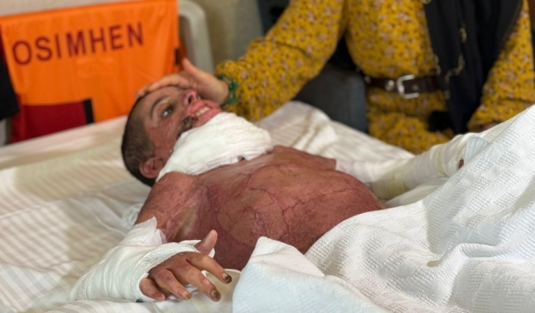 Vücudunun yüzde 50'si yanan Mustafa, yapay deri nakliyle hayata tutundu