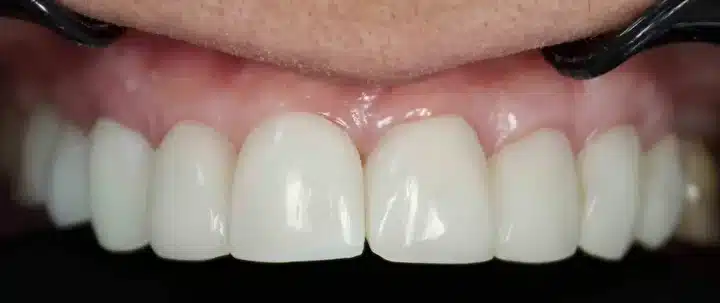 Sivaslı Akademisyenden Diş Tedavisinde Devrim: İmplant Yerine 4 Seansta Doğal Dişe Dönüş (resim 2) – saglikhaberi.net Sivaslı Akademisyenden Diş Tedavisinde Devrim: İmplant Yerine 4 Seansta Doğal Dişe Dönüş (resim 1) – saglikhaberi.net