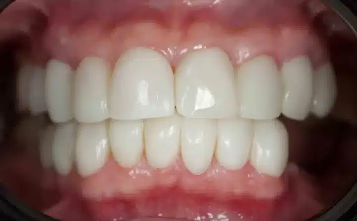 Sivaslı Akademisyenden Diş Tedavisinde Devrim: İmplant Yerine 4 Seansta Doğal Dişe Dönüş (resim 4) – saglikhaberi.net Sivaslı Akademisyenden Diş Tedavisinde Devrim: İmplant Yerine 4 Seansta Doğal Dişe Dönüş (resim 3) – saglikhaberi.net