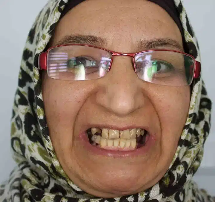 Sivaslı Akademisyenden Diş Tedavisinde Devrim: İmplant Yerine 4 Seansta Doğal Dişe Dönüş (resim 2) – saglikhaberi.net Sivaslı Akademisyenden Diş Tedavisinde Devrim: İmplant Yerine 4 Seansta Doğal Dişe Dönüş (resim 1) – saglikhaberi.net