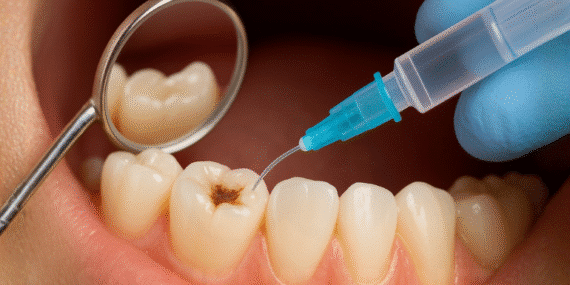 Diş Onaran Jel Çürükleri Tarihe Karıştırabilir