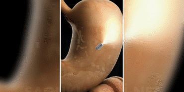 endoskopi tarih oluyor Yapay Zekâlı Kapsül