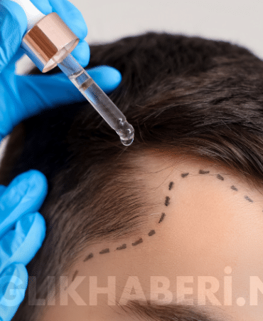 saç ekimi