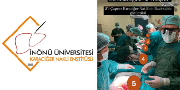 İnönü Üniversitesi Karaciğer Transplantasyon Enstitüsü 5'li Nakil
