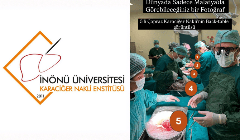 İnönü Üniversitesi Karaciğer Transplantasyon Enstitüsü 5'li Nakil