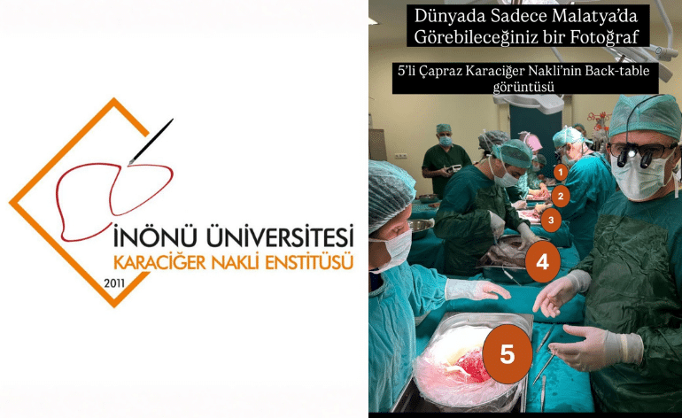 İnönü Üniversitesi Karaciğer Transplantasyon Enstitüsü 5'li Nakil