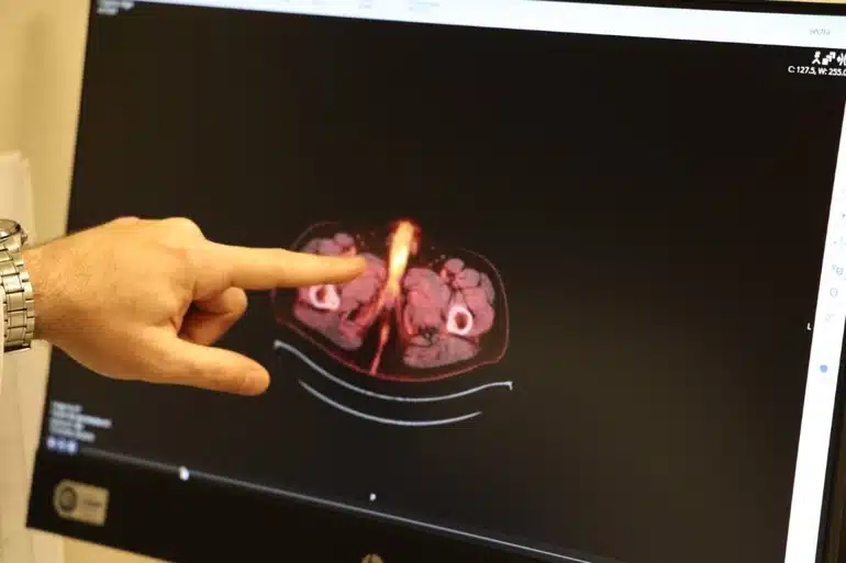 Diyarbakır'da Nadir Vaka: Kolon Kanseri Nedeniyle 38 Yaşındaki Hastanın Penisi Alındı (resim 5) – saglikhaberi.net