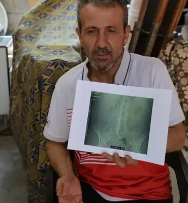 Ameliyatta Skandal İddia: Hastanın Belinde Cerrahi Alet Unutuldu! (resim 5) – saglikhaberi.net Ameliyatta Skandal İddia Hastanın Belinde Cerrahi Alet Unutuldu