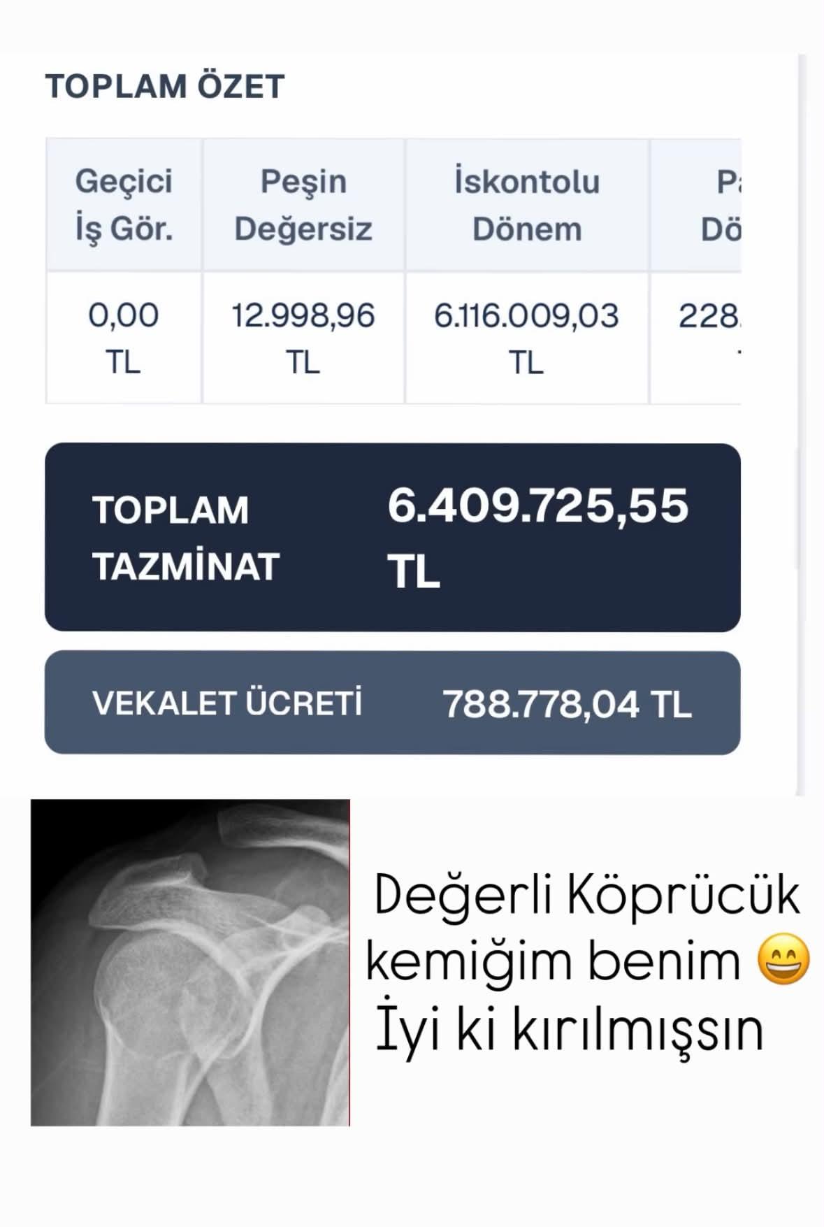 Kırılan Köprücük Kemiğine 6,4 Milyon TL Tazminat: Sosyal Medyada Paylaştığı İtiraf Gündem Oldu! (resim 1) – saglikhaberi.net
